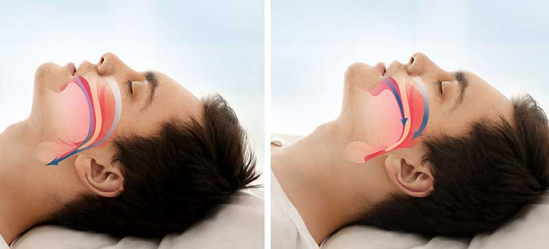 Snoring and Sleep Apnoea Clinic in Khar