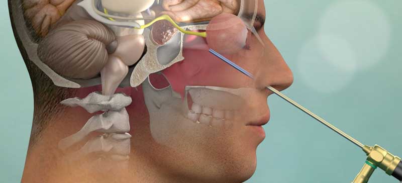 Endoscopic Transnasal Skull Base Surgery